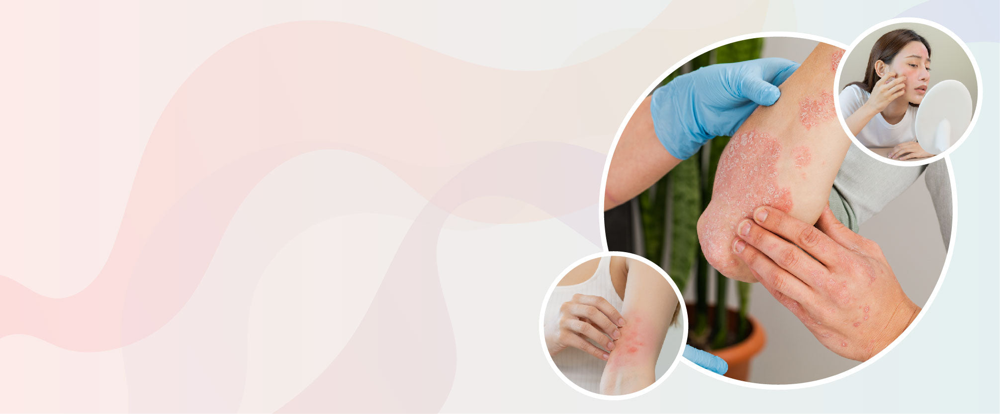 The Best Eczema Treatment Products and Kits