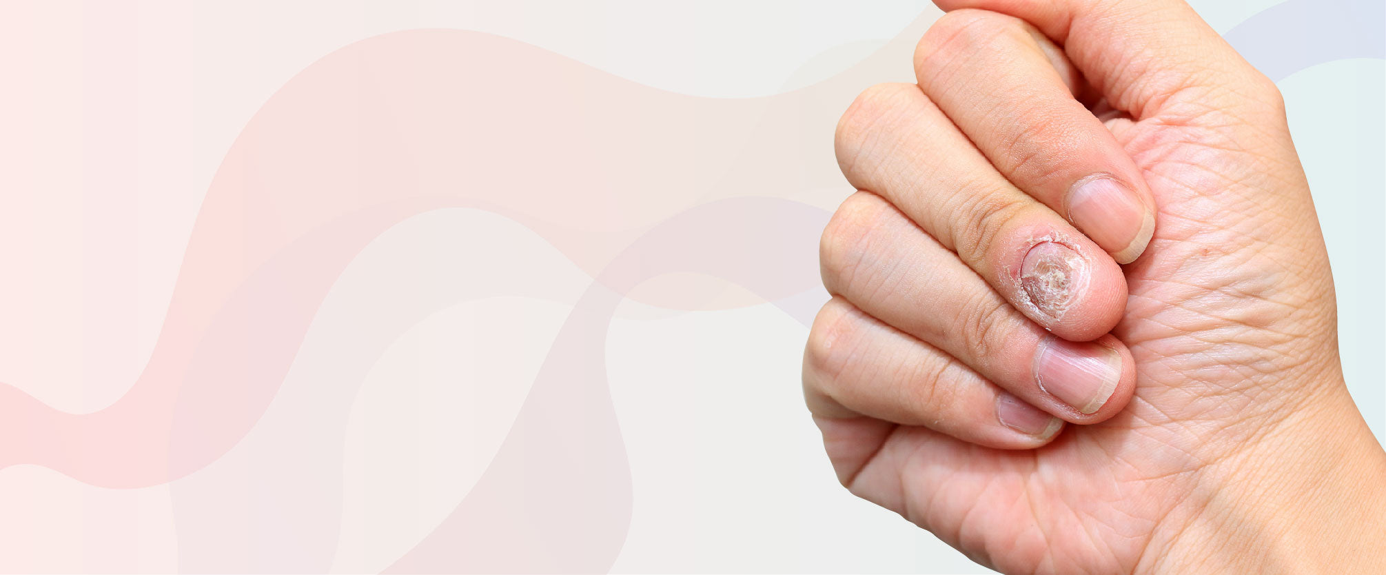 The Best Nail Fungus Treatment Products and Kits
