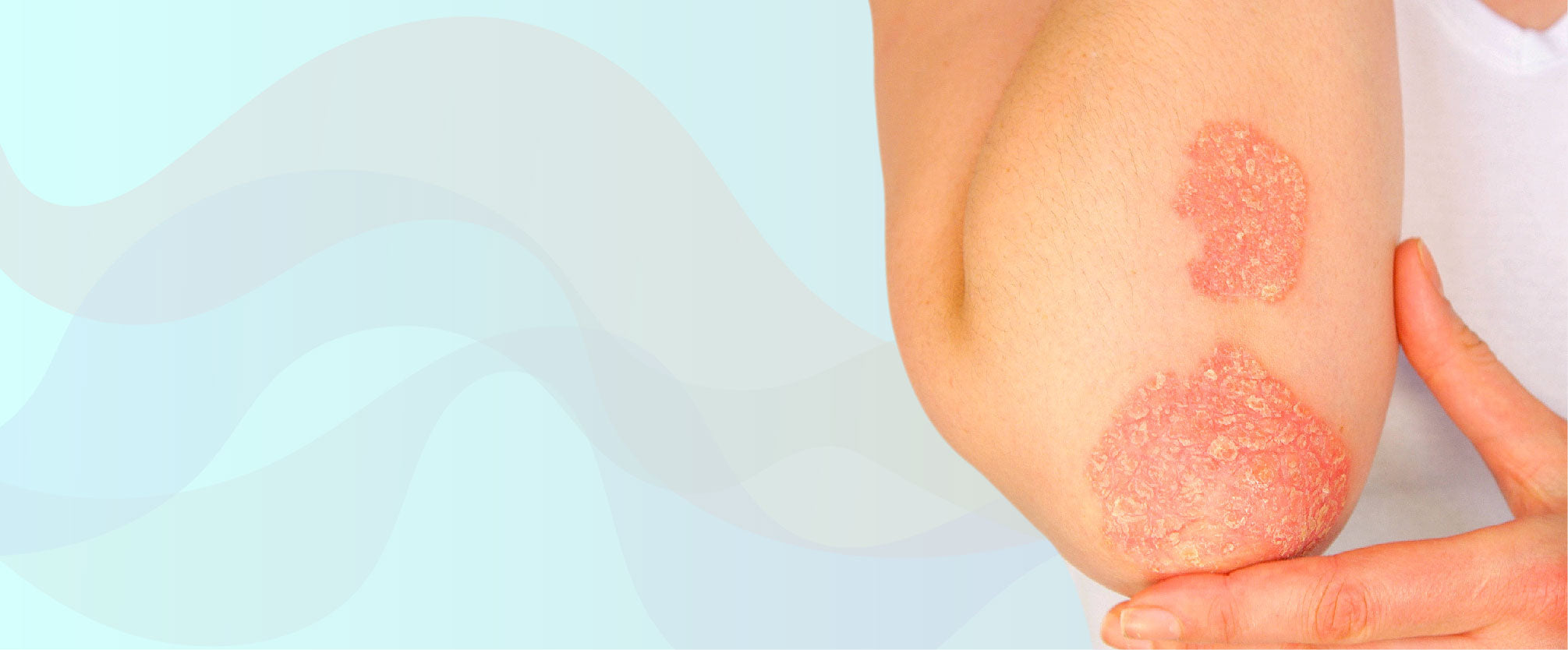 The Best Psoriasis Treatment Products and Kits